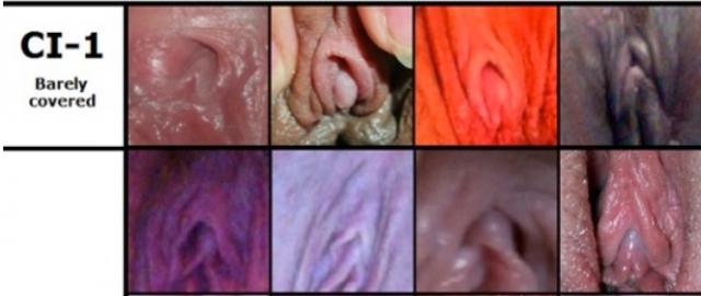 The Variation of Clitoral Hoods